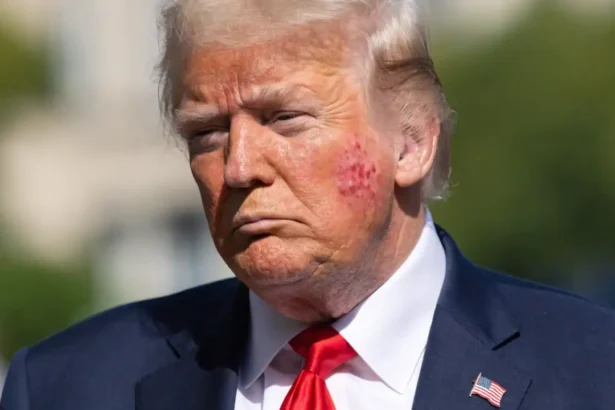 Does Trump Have Shingles The Facts Behind the Rash