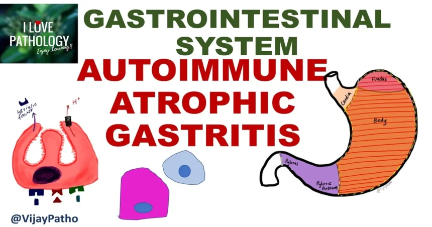 autoimmune gastritis bryan johnson
