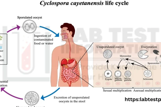 cyclosporiasis
